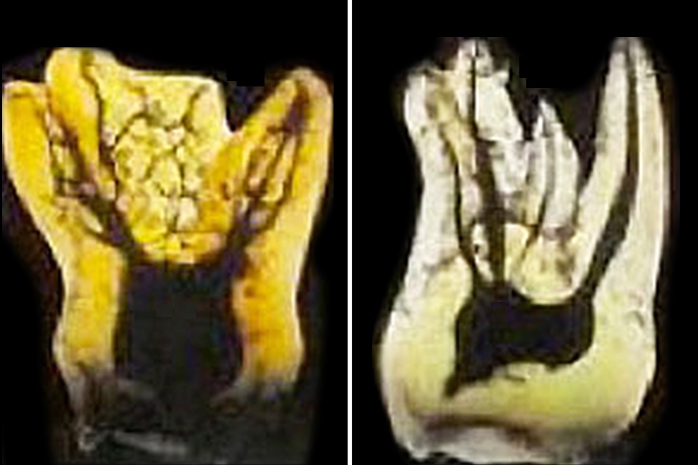 歯髄CT像